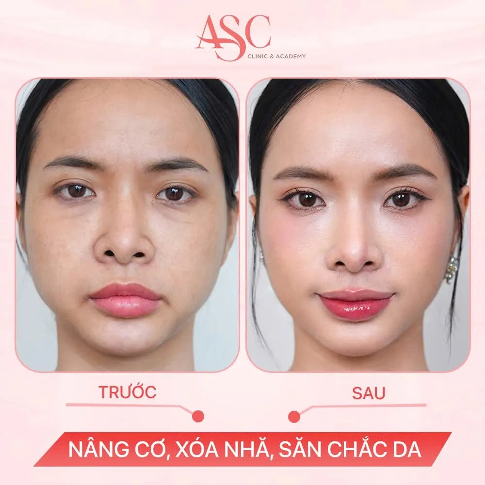 CN Revlite - Trị Nám