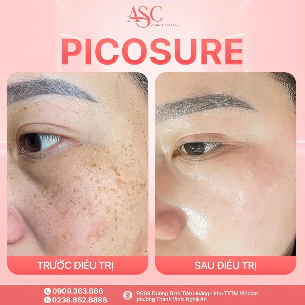 Công Nghệ Picosure - Trị Nam
