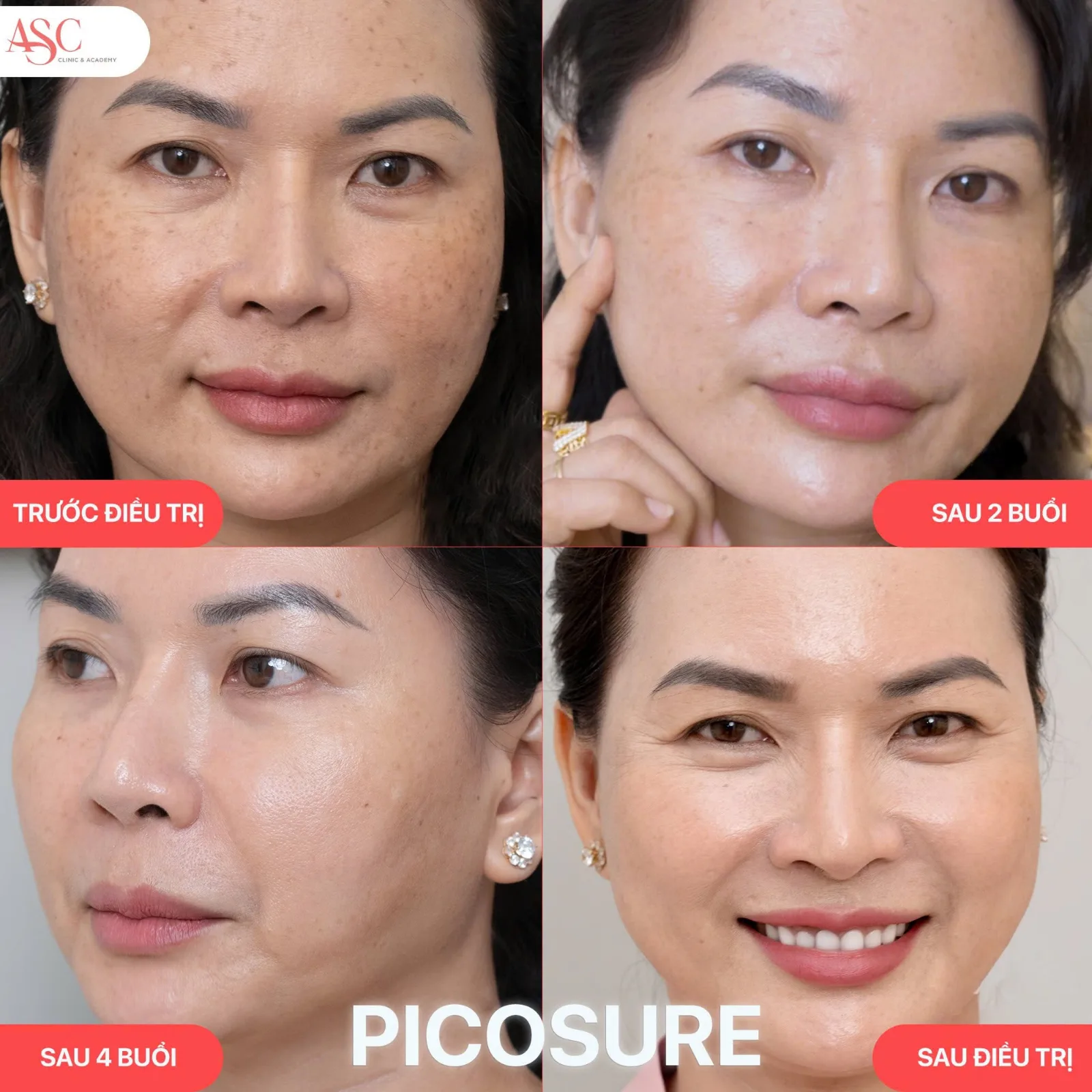 Công Nghệ Picosure - Trị Nam