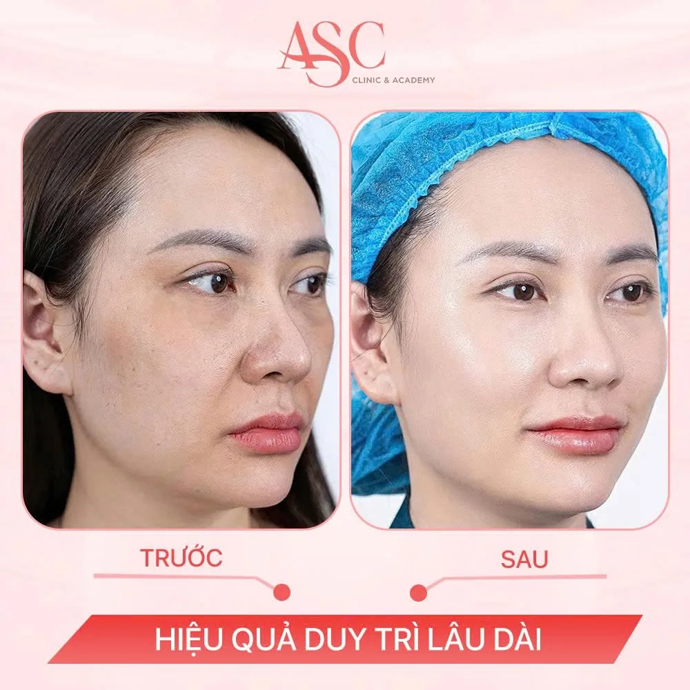 5 sai lầm phổ biến khiến nám ngày càng nặng hơn và cách chăm sóc đúng