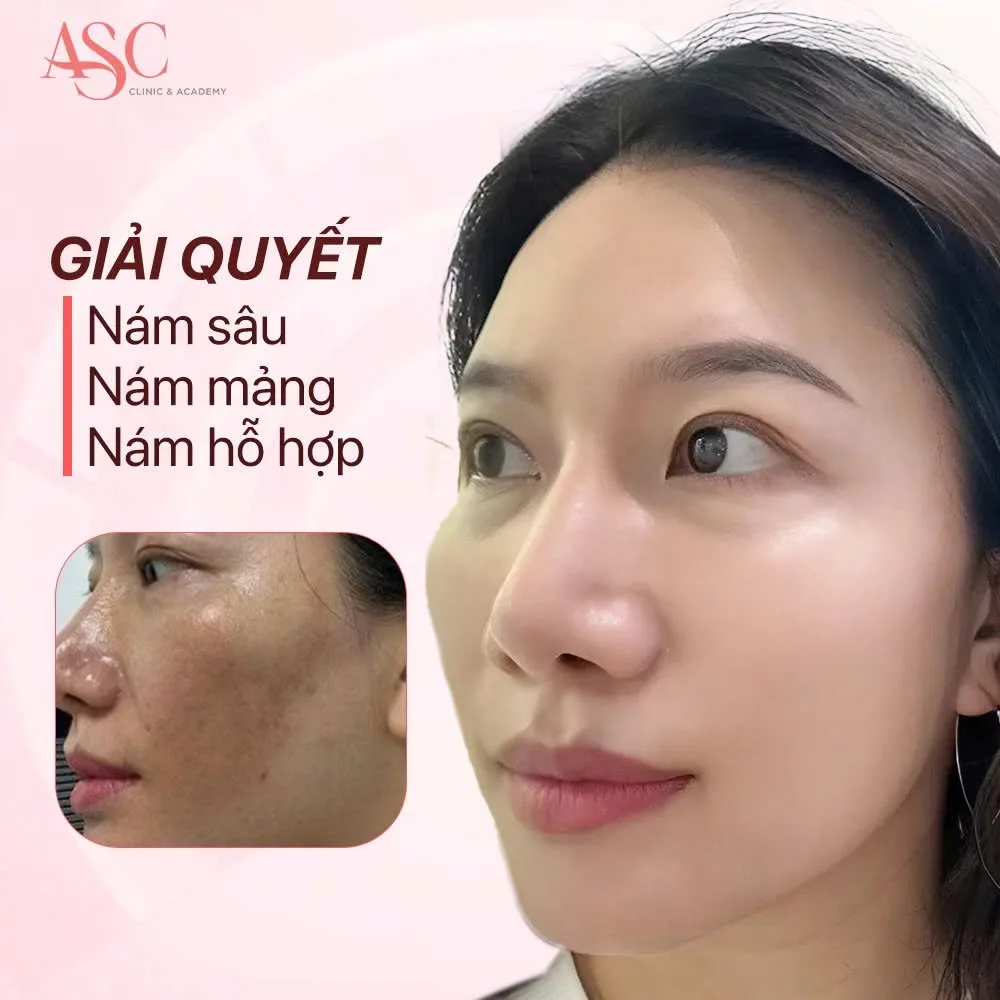Hình ảnh Công Nghệ Picosure - Trị Nam